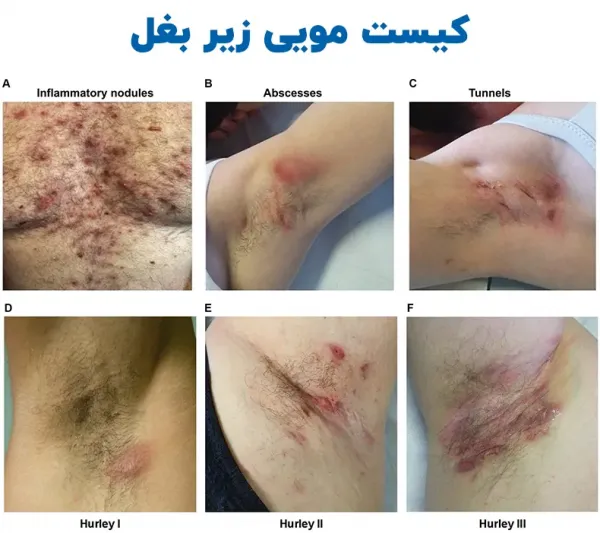  کیست زیر بغل چه علائمی دارد؟