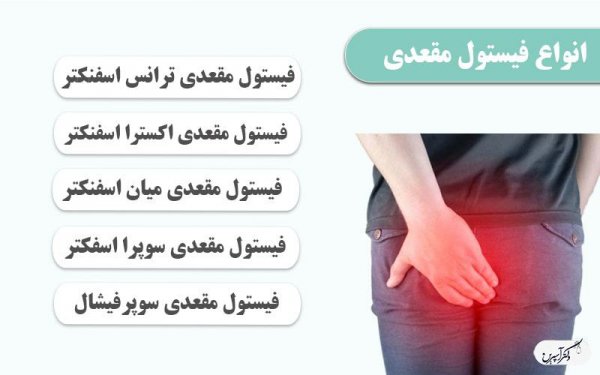  فیستول مقعدی چگونه به وجود می آید؟