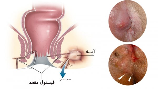  فیستول مقعدی چگونه به وجود می آید؟