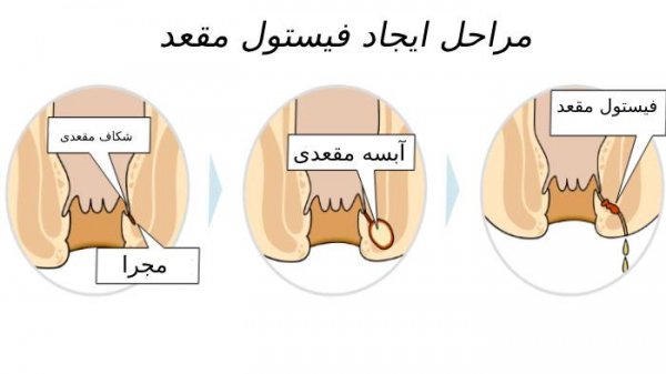  فیستول مقعدی چگونه به وجود می آید؟