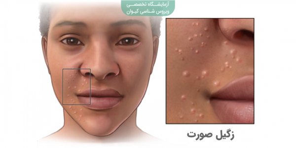 عکس زگیل صورت + انواع زگیل صورت + درمان