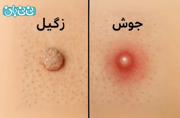  عکس زگیل صورت + انواع زگیل صورت + درمان