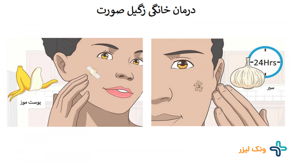  عکس زگیل صورت + انواع زگیل صورت + درمان