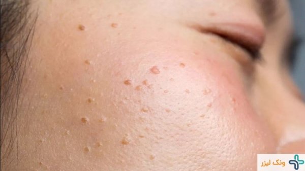 عکس زگیل صورت + انواع زگیل صورت + درمان