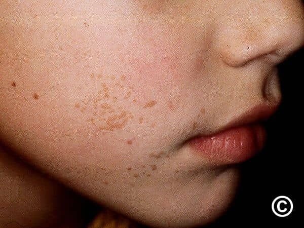  عکس زگیل صورت + انواع زگیل صورت + درمان