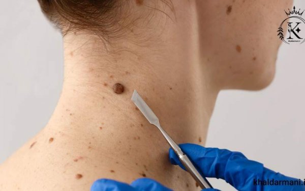  درمان زگیل صورت در طب سنتی + پماد زگیل صورت