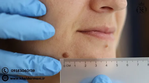  زگیل روی صورت نشانه چیست؟