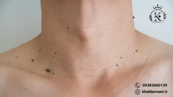  زگیل روی صورت نشانه چیست؟