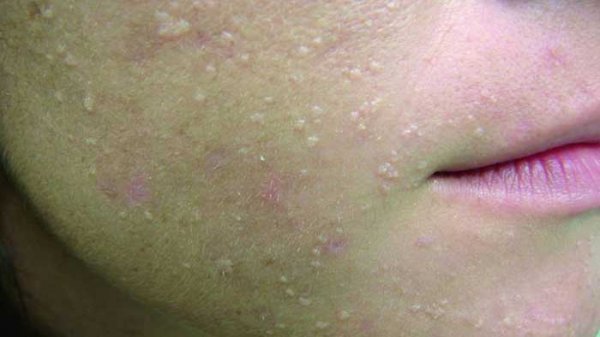  زگیل روی صورت نشانه چیست؟