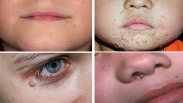  زگیل روی صورت نشانه چیست؟