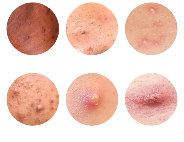  زگیل صورت بر / در اثر چیست + علائم زگیل صورت