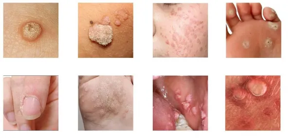  زگیل صورت بر / در اثر چیست + علائم زگیل صورت