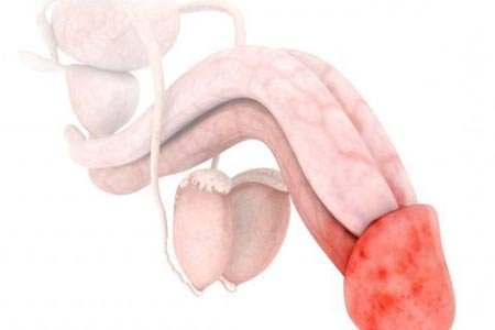  عکس ترک پوست در ناحیه تناسلی مردان