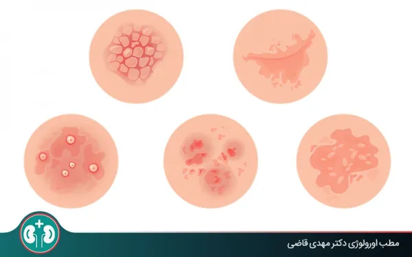  عکس ترک پوست در ناحیه تناسلی مردان