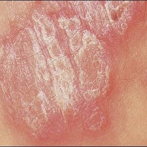  عکس ترک پوست در ناحیه تناسلی مردان