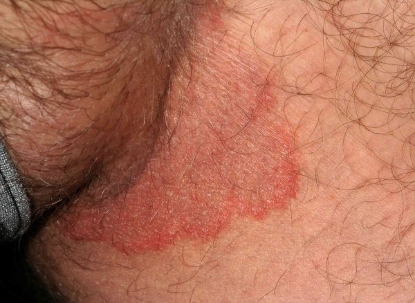  عکس ترک پوست در ناحیه تناسلی مردان