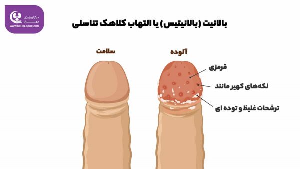  عکس ترک پوست در ناحیه تناسلی مردان
