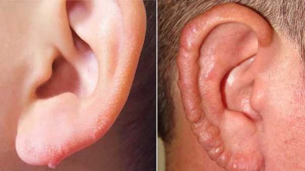  زگیل صورت چه شکلی است؟