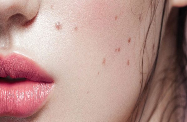  زگیل صورت چه شکلی است؟