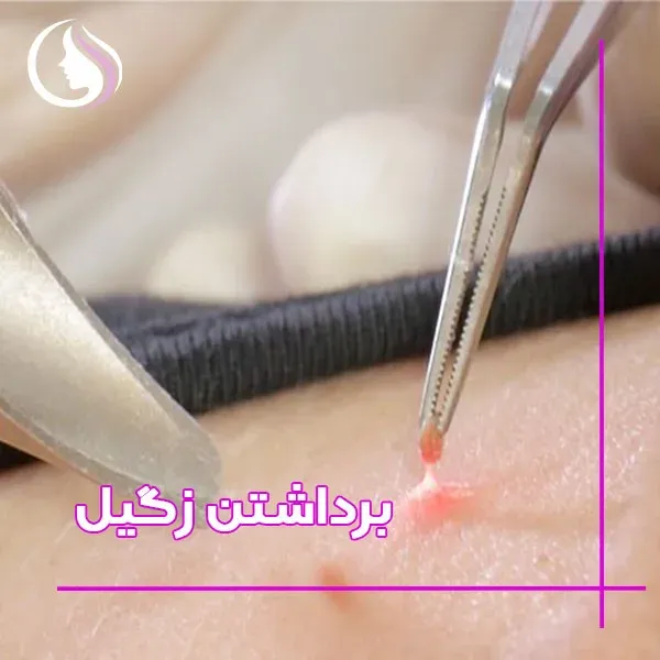  زگیل صورت چه شکلی است؟