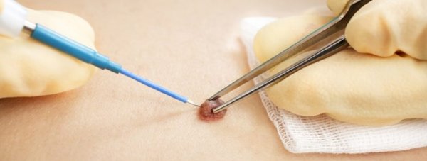  زگیل صورت چه شکلی است؟