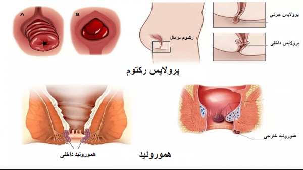  عکس توده سفت زیر پوست در ناحیه تناسلی زنان
