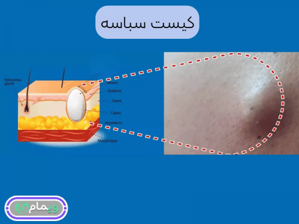  عکس توده سفت زیر پوست در ناحیه تناسلی زنان