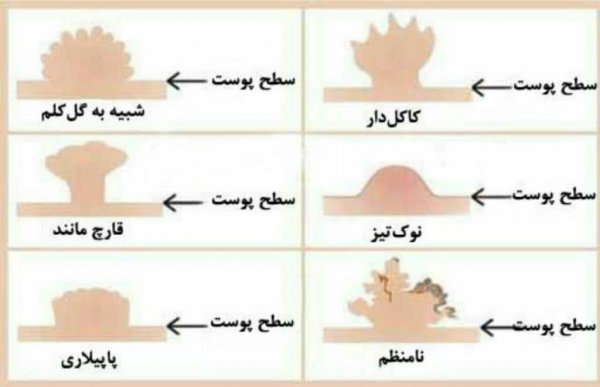  عکس توده سفت زیر پوست در ناحیه تناسلی مردان