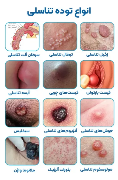 عکس توده سفت زیر پوست در ناحیه تناسلی مردان