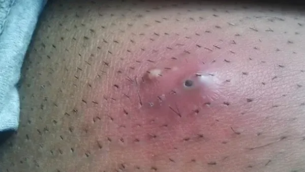  عکس توده سفت زیر پوست در ناحیه تناسلی مردان