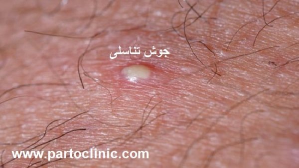  عکس توده سفت زیر پوست در ناحیه تناسلی مردان