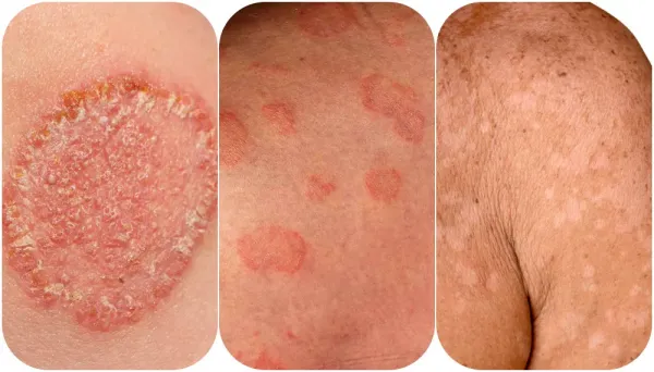  عکس قارچ دستگاه تناسلی مردان + درمان خانگی قارچ دستگاه تناسلی مردان