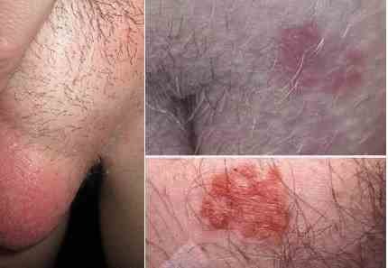  عکس قارچ دستگاه تناسلی مردان + درمان خانگی قارچ دستگاه تناسلی مردان