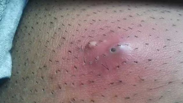  انواع جوش تناسلی مردان + علت و درمان + عکس واضح و واقعی