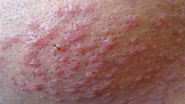  انواع جوش تناسلی مردان + علت و درمان + عکس واضح و واقعی