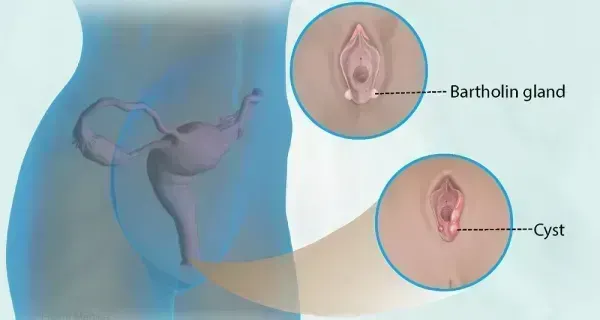 انواع غده در واژن + عکس