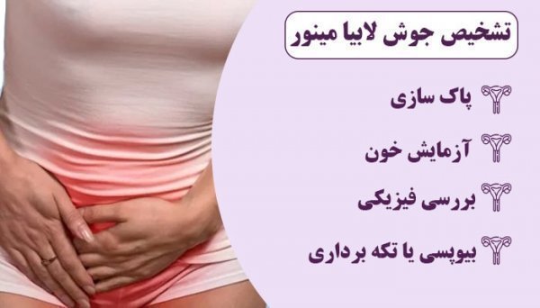 انواع غده در واژن + عکس