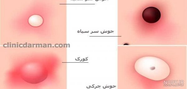  انواع غده در واژن + عکس
