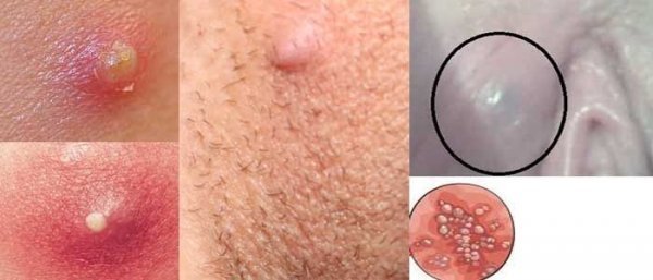  انواع غده در واژن + عکس