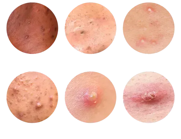  انواع غده در واژن + عکس