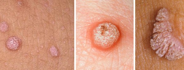 عکس جوش سفت و دردناک واژن + روش‌های درمان جوش واژن