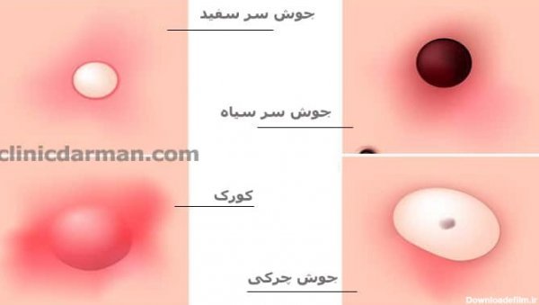 عکس جوش سفت و دردناک واژن + روش‌های درمان جوش واژن