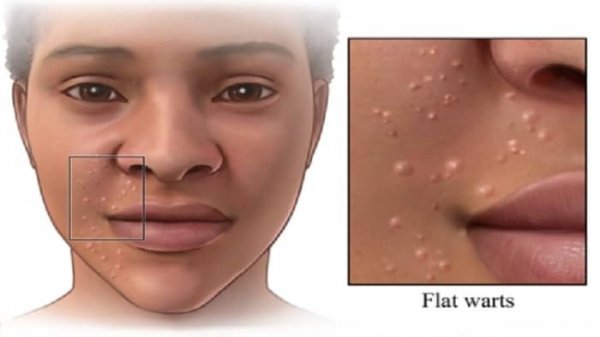  آیا زگیل صورت خطرناک است